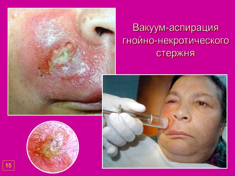 Вакуум-аспирация гнойно-некротического стержня 15